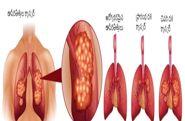 symptom of lung cancer