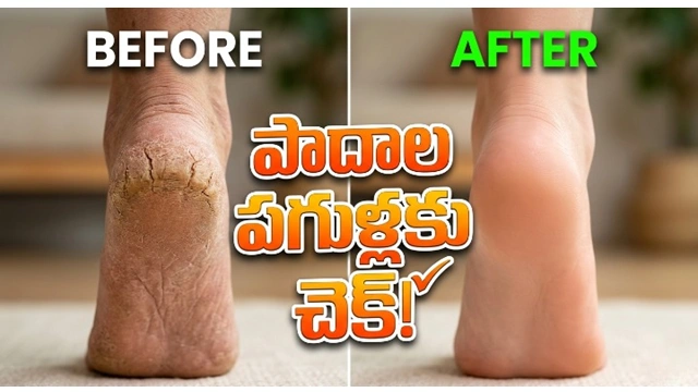 Cracked heels home remedies telugu tips